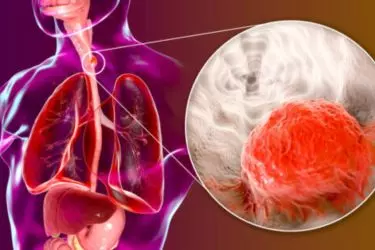 best hospital for treatment of food pipe cancer, best doctor for esophageal cancer surgery, cost of treatment of esophagus or cancer of food pipe, Jiva Hospital mohali punjab india