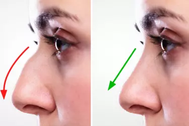 best hospital for nose correction surgery in purnia, best doctor for rhinoplasty surgery in purnia, cost of nose correction surgery in purnia
